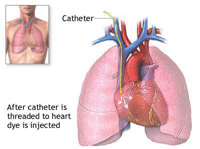Cardiac Catheterization